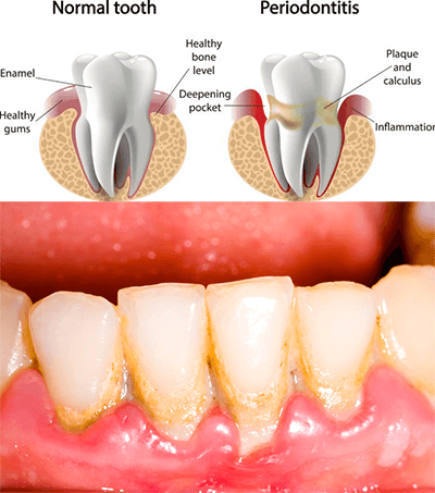 Gum Disease Treatment Youngstown