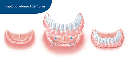 Implant Retained Dentures Youngstown